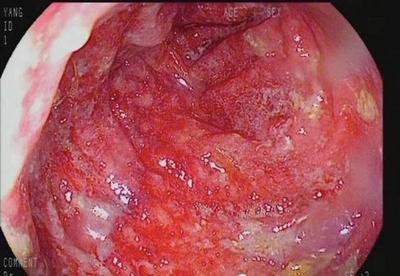 老年腹痛便血可能是缺血性肠病