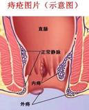 节日流行病肛肠三妖精