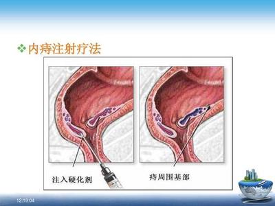 痔疮注射治疗法