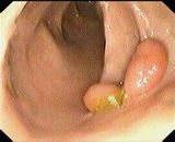 是痔是癌一眼看得见——肠镜肠道息肉