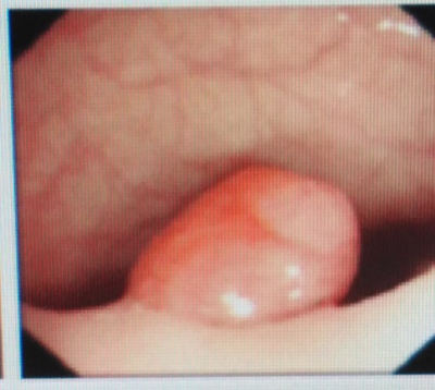 为什么要做肠镜