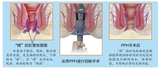 PPH手术