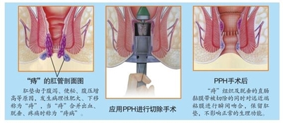 PPH手术