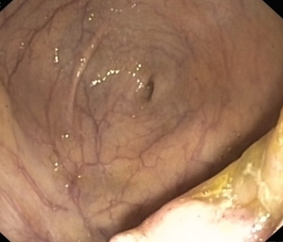 糖尿病做肠镜很有必要